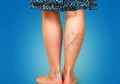Pembuluh Laba-Laba Buat Kaki Tak Cantik? Coba Bahan Ini untuk Hilangkannya