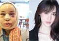 (Foto) Cantik Hasil Operasi Plastik Tidaklah Instan, Wajah Wanita Ini Harus Bengkak Selama 3 Bulan Terlebih Dahulu, 'Cantik Itu Luka'?