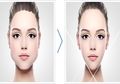 10 Fakta Sedot Lemak di Dagu, Permanen, Tidak Sakit, dan Sering Dilakukan Wanita Usia 40 Tahun ke Atas