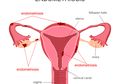 Endometriosis Penyakit Wanita, Gejalanya Bisa Sakit di Anus Saat BAB