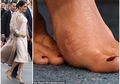 Bertelanjang Kaki, Meghan Markle Disebut Pernah Operasi Karena Bunion, Apa Itu?