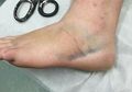 Waspadai Kaki Menghitam Pada Pasien Covid-19, Penting Cek Saturasi di Jari Kaki, Harus Sama dengan Tangan
