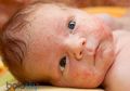 Anak Miliki Benjolan Seperti Jerawat? Bisa Jadi Moluskum Kontagiosum, Obati dengan Bahan Alami Ini!