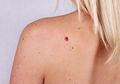 Berawal dari Munculnya Tahi Lalat, Ini Fakta tentang Kanker Kulit Melanoma yang Wajib Kita Tahu!