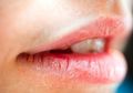 Bibir Kering dan Pecah-pecah, Jangan Khawatir, Atasi dengan 4 Bahan Rumahan Ini