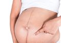 Tidak Sedang Hamil Tapi Muncul Garis Samar yang Ada di Perut Perempuan? Jangan Khawatir, Ini Artinya