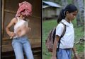 Lahir dengan 2 Lengan Ekstra yang Tumbuh di Dadanya, Gadis Ini Merawat Seperti Kembarannya