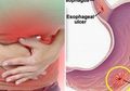 Awas Terserang GERD sampai Kanker Saat Asam Lambung Kamu Naik!