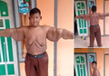 Mengenal Operasi Bariatrik, Yang Bisa Bantu Arya Permana Susutkan 100 kg Berat Badannya