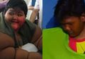 Operasi Bariatrik, Operasi Penyempitan Rongga Lambung yang Buat Berat Badan Arya Permana Turun Drastis