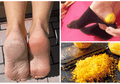 Tumit Kaki Anda Pecah-pecah? Gunakan Kulit Lemon untuk Menyembuhkannya!