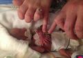 Kisah Ajaib Bayi yang Lahir dengan Tangan Seukuran Cincin: Disangka Akan Meninggal, Seperti Ini Hidupnya Setelah 3 Tahun