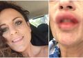 Ingin Terlihat Seksi dengan Suntik Filler, Tapi Hasilnya Bibir Wanita Ini Justru Rusak