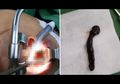 Dikira Tumor, Dokter Justru Temukan Lintah di Tenggorokan Perempuan Ini!