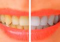 5 Cara Alami untuk Mendapatkan Senyum Seputih Mutiara