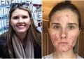 Wanita dengan Jerawat Kistik Tampil Tanpa Make up untuk Pertama Kalinya: Apa itu Jerawat Kistik? Bagaimana Penyebarannya?