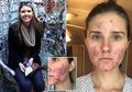Penata Gaya Ini Tak Dapat Pergi Tanpa Make Up Akibat Jerawat Kistik