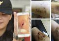 7 Pria Alami Infeksi Mengerikan Usai Dipijat di Panti Pijat, Bakterinya Kebal Antibiotik!