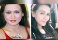 Nekat Lakukan Operasi Plastik, Pedangdut Nita Thalia Alami Kelumpuhan Wajah, Ini Gejala yang Sering Dialami