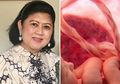 Ani Yudhoyono Idap Kanker Darah, Terkuak Tali Pusar Bisa Jadi Penyembuh, Kok Bisa?