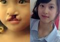 Begini Prosedur Operasi Bibir Sumbing Anak yang Dibuang Orangtuanya Sekarang Tampil Cantik