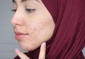 Cara Mengatasi Masalah Kulit Berjerawat untuk Pemakai Hijab dari Pakar Kulit