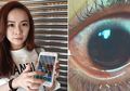 Mata Wanita ini Berakhir Mengerikan, Akibat Bermain Ponsel dengan Kecerahan Layar Maksimal!