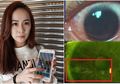 Ada 500 'Lubang' di Kornea Mata Gadis Ini, Akibat Sering Menatap Layar Ponsel dengan Tingkat Kecerahan Maksimal!