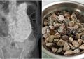 Mengeluh Sakit Perut Teramat Sangat Selama Seminggu, Dokter Temukan Kerikil & Koin Seberat 2kg di Perut Pria Ini!