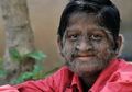 Kisah Bocah Langka di India yang Tubuhnya Dipenuhi Rambut Mirip Bak Serigala, Apa Penyebabnya?
