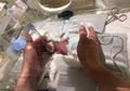 Kisah Bayi Terkecil di Dunia Asal Jepang, Hanya Seukuran Telapak Tangan Orang Dewasa!