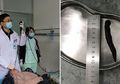 Lintah Sepanjang 10 Cm Ditemukan di Tenggorokan Pria Ini Setelah Minum Air, Perhatikan Hal Ini Pada Air Minum Anda!