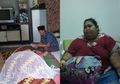 Sempat Jalani Operasi Bedah Lambung, Sunarti Penderita Obesitas Berbobot 148 Kg Meninggal Dunia