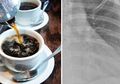 Pecinta Kopi Harus Waspada! Tulang Rusuk Wanita 30 Tahun Ini Keropos Karena Minum Kopi Setiap Hari!