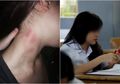 Seorang Ibu Kaget Lihat 'Cupang' di Leher Putrinya, Sang Anak Akhirnya Mengaku Telah Berhubungan Intim dengan 5 Pria