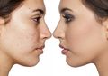Buatnya Cuma #5MenitAja, 5 Masker Alami Ini Ampuh Hilangkan Bekas Jerawat!
