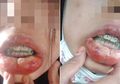 Pasang Kawat Gigi Palsu, Bibir Gadis Ini Langsung Bengkak Bernanah Hingga Alami Demam Tinggi