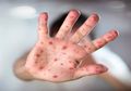 Penting! Ternyata Inilah Cara Cegah Terjangkit Virus Cacar Monyet