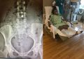 Ngeri! Seorang Ibu Muda Kehilangan Indung Telur, Rahim dan Jari Kakinya Akibat Alat Kontrasepsi