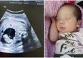 Terjadi Lagi, Bayi Baru Lahir Ini 'Mengandung' Janin Kembarannya Sendiri Sejak dalam Kandungan