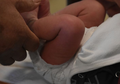 Bayi Laki-laki Berusia 5 Bulan Tewas saat Lakukan Sunat yang 'Gagal'