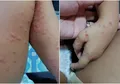 Mengobati Flu Singapura, Penyakit Infeksi Menular yang Lebih Sering Terjadi Pada Anak