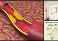 Alami Penyumbatan Arteri? Ternyata Puasa Dapat Mengatasinya Lho!