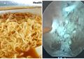 Iklan Lama Keluarga yang Setiap Hari Makan Mi Instan Viral Kembali, Ini yang Terjadi pada Perut saat Kita Setiap Hari Makan Mi Instan