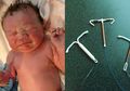 Viral Bayi Lahir dengan Menggenggam Alat KB Spiral Ibunya, Alat KB Spiral Tak Efektif?