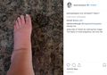 Jessica Simpson Unggah Foto Kaki Bengkak Bikin Heboh, Ini Kata Medis