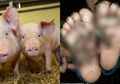 Berjalan di Kandang Babi Tanpa Sepatu, Telapak Kaki Gadis Ini Terkena Infeksi Mengerikan