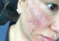 Niatnya Ingin Cantik, Kulit 3 Wanita Ini Malah Terbakar Saat Lakukan Laser Hair Removal!