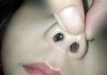Gadis Kecil Ini Alami Demam Sebulan Penuh, Setelah Diperiksa Ternyata Ada Benda Asing di Hidungnya!