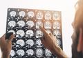 Mengenal Metode Baru Tangani Tumor Otak Melalui Alis, Risiko Lebih Kecil dan Bekas Jahitan Tak Terlihat